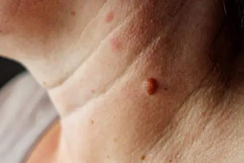 photo of mole on a woman's neck