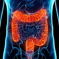 photo of irritable bowel disease