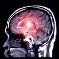 photo of stroke concept