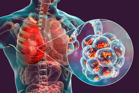 photo of bacterial lung infection