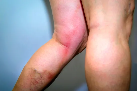 photo of deep vein thrombosis
