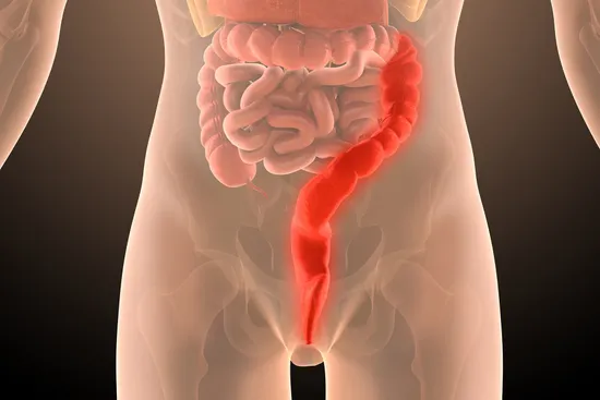 photo of Ulcerative colitis illustration