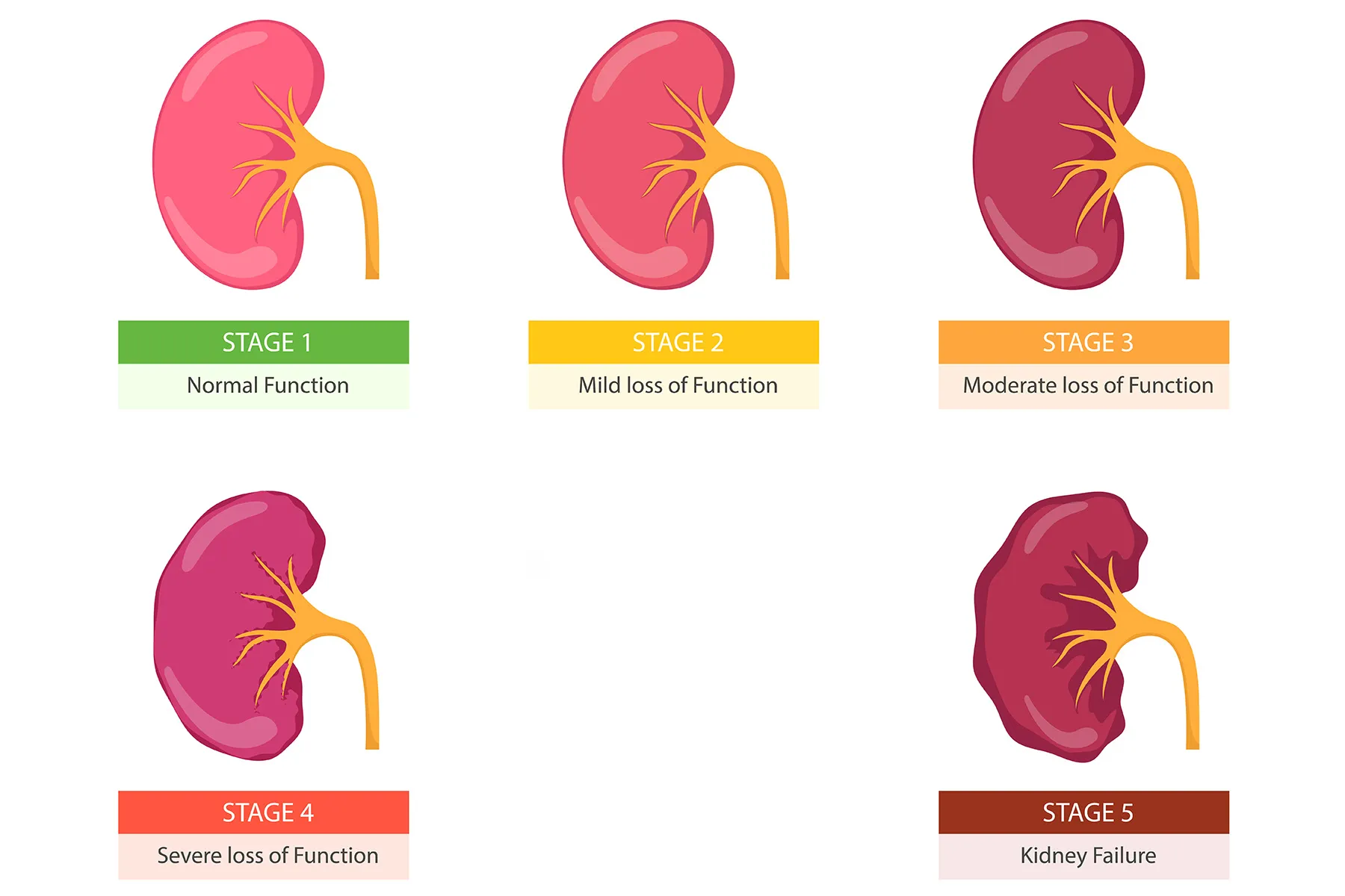 Acute Kidney (Renal) Failure: Symptoms, Causes, Treatment & Prevention