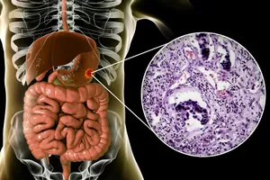 Adenocarcinoma can strike many areas of the body, including the stomach. (Photo credit: Katerina Kon/Dreamstime)