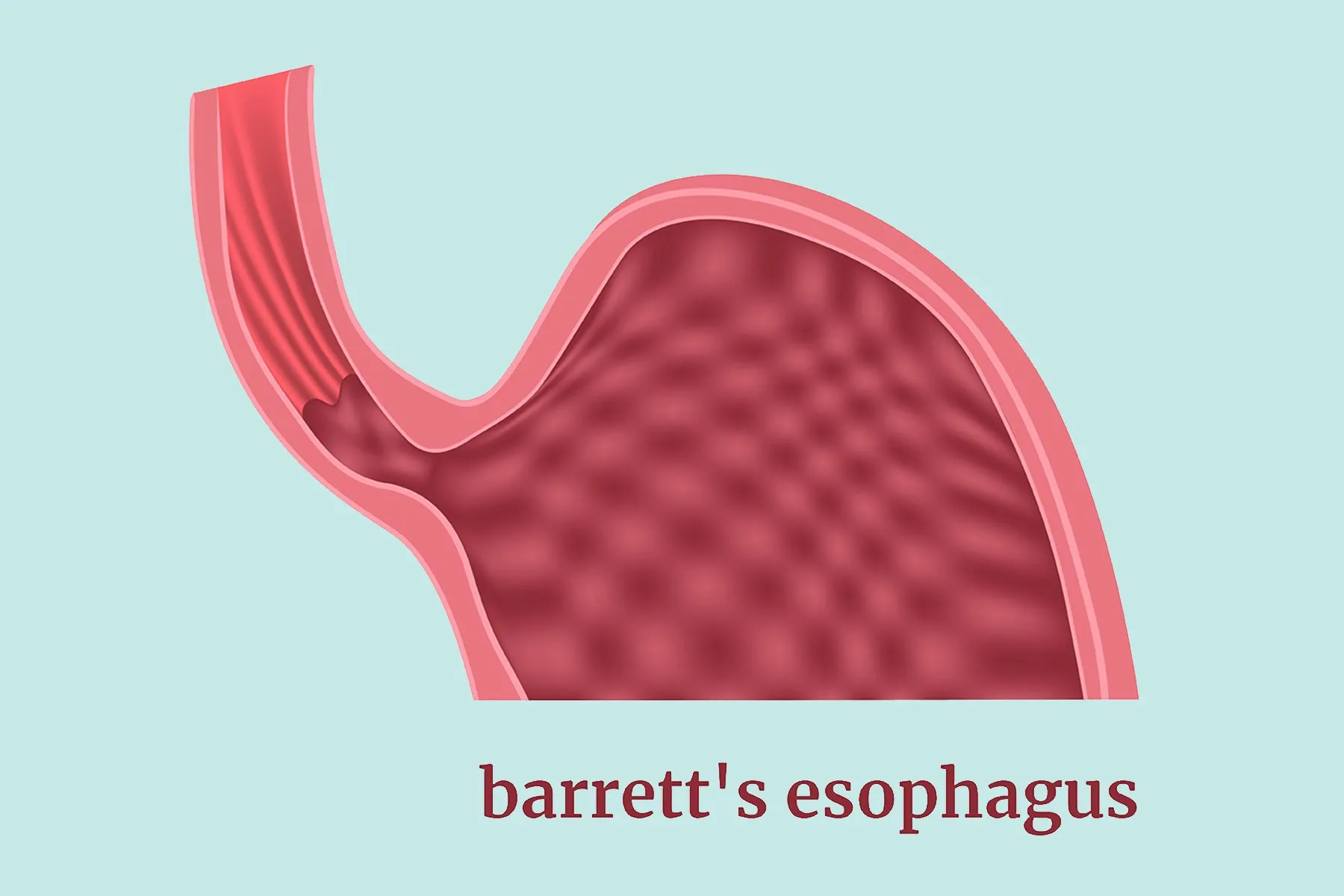Barrett's Esophagus Symptoms, Causes, and Treatments