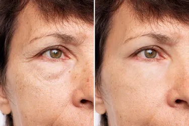 Blepharoplasty removes excess skin from above your eyes to help you see better. (Photo credit: iStock/Getty Images)