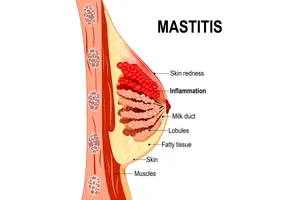 Mastitis is an infection of breast tissue that happens most often when breastfeeding but can occur at other times as well. Image credit: Designua / Dreamstime