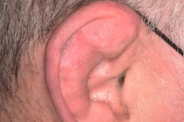 Cauliflower ear, sometimes called boxer's ear, is a deformity of the ear that results from an injury. (Photo Credit: Science Source)