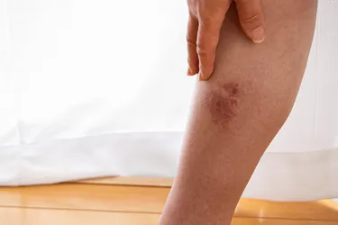 Cellulitis is a bacterial infection that can develop from a break or cut in your skin. (Photo Credit: iStock/Getty Images)