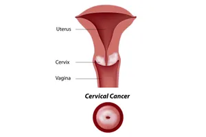 Cervical cancer affects the cervix, the lower, narrow part of the uterus (womb). (Photo credit: Alila07/Dreamstime)