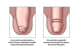 photo of Circumcision