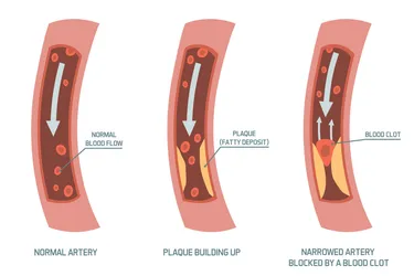 Atherosclerotic coronary artery disease is when plaque builds up along the walls of the arteries to your heart. (Photo credit: iStock/Getty Images)