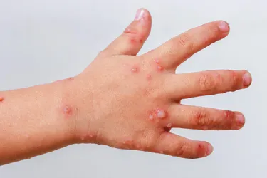Coxsackievirus is most common in children and causes a blistery rash on the hands and feet. (Photo credit: Saman Sukjit/Dreamstime)
