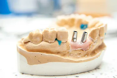 Dental implants are replacement roots for missing teeth. They're often more comfortable and help maintain your jaw and face shape better than dentures. (Photo Credit: E+/Getty Images)