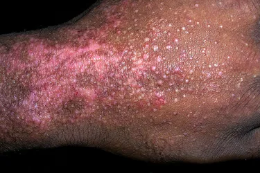 Dermatitis can cause itchy, dry, and red skin with crusty scales, cracks, or blisters that ooze. It may show up differently on various shades of skin. (Photo credit: Science Source)