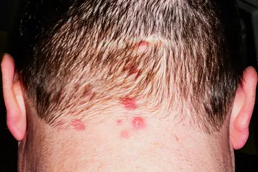 Dermatitis herpetiformis is a very itchy rash that often shows up on the scalp. (Photo credit: iStock/Getty Images)