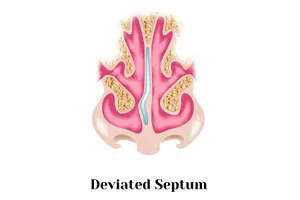 A deviated septum may limit your ability to breathe through your nose. (Photo credit: Mrsbazilio/Dreamstime)