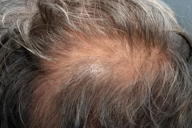 Telogen effluvium is a more gradual thinning of the hair, compared to anagen effluvium, which happens very quickly. (Photo credit: Science Source)