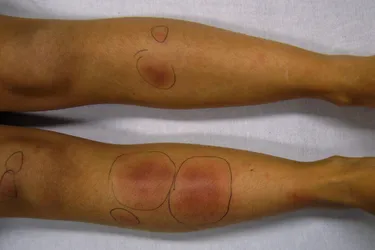 The tender lumps of erythema nodosum usually appear on your shins. (Photo credit: Wikimedia Commons)