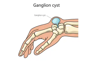photo of Ganglion cyst 