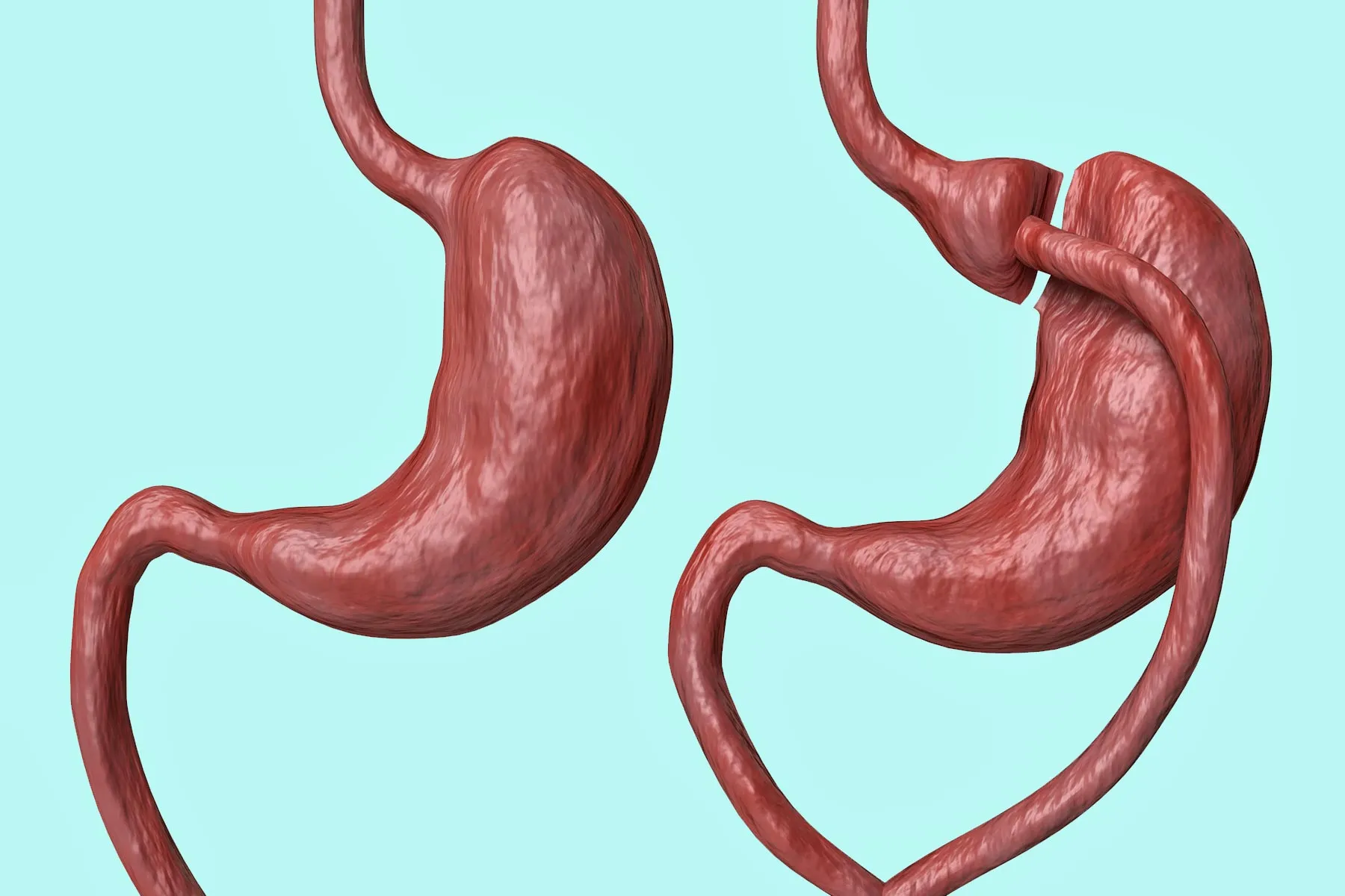 Dumping Syndrome Causes, Symptoms, Prevention, and Treatments