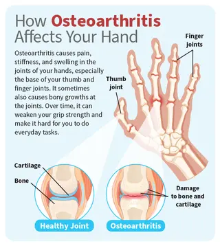 hand osteoarthritis bigbead