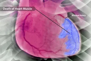 A heart attack happens when the flow of blood and oxygen to your heart is blocked, causing the death of heart muscle tissue. (Photo Credit: BSIP / Medical Images)