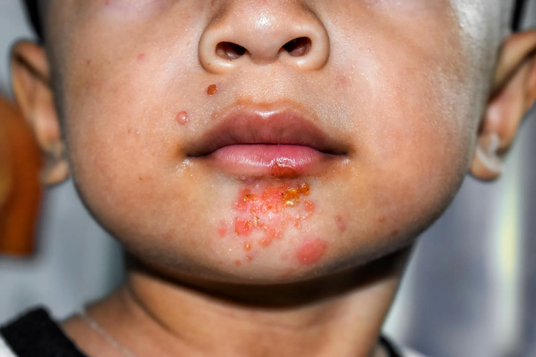 Impetigo symptoms causes complications and treatments