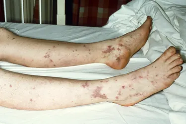Meningitis can cause a rash that starts small and looks like pinpricks before spreading into red or purple splotches. It can be hard to spot if your skin tone is darker – check the palms of your hands and the soles of your feet. (Photo Credit: John Radcliffe Hospital/Science Source)