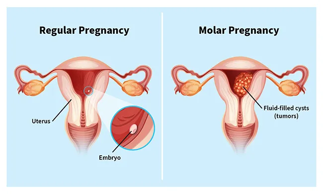 illustration of molar pregnancy