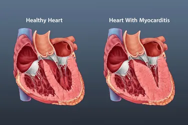 It's important to recognize the signs of myocarditis, an inflammation of your heart muscle, as it can weaken your heart and cause more health issues. (Photo Credit: Catherine Twomey/Science Source)