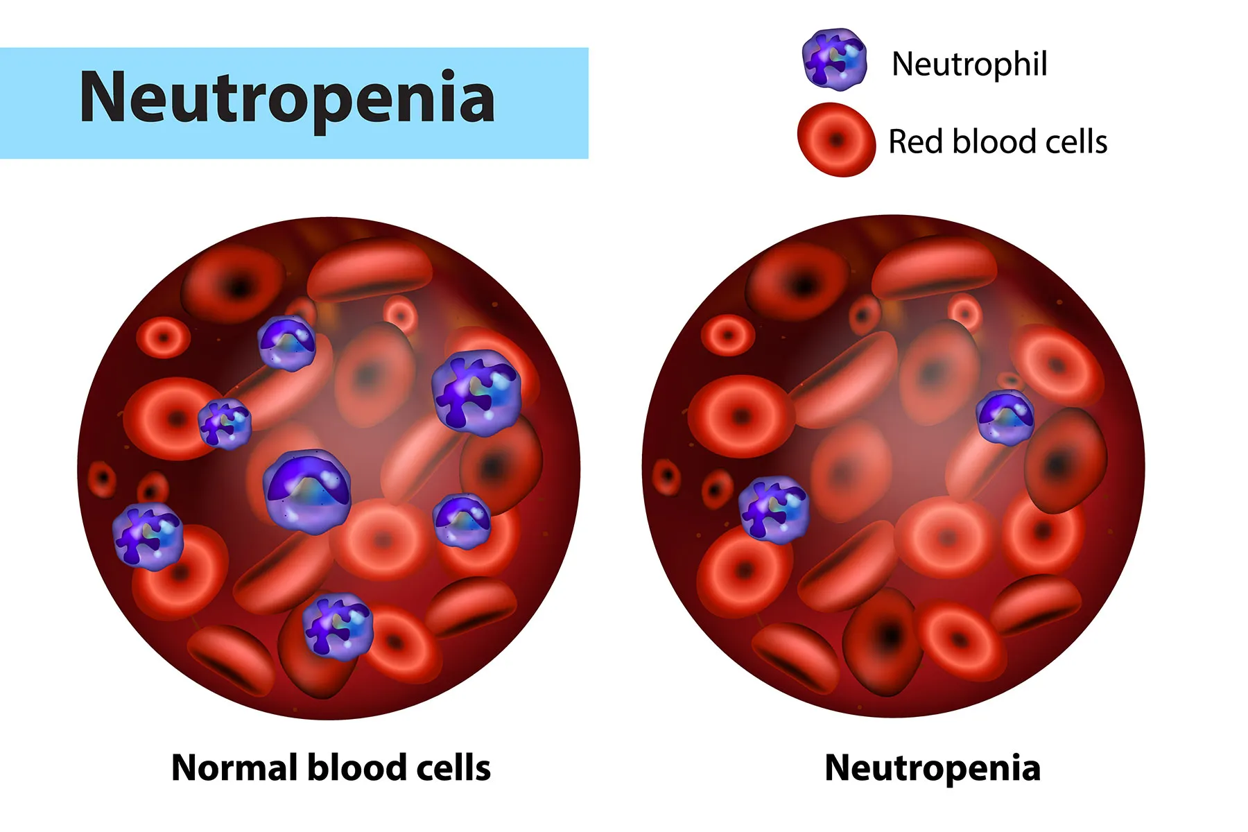 Neutropenia Causes, Symptoms, and Treatment