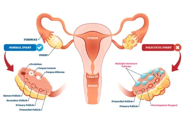 Polycystic ovaries are those that have lots of immature egg sac cysts (follicles). Not everyone with PCOS has ovarian cysts. (Photo credit: iStock/Getty Images)