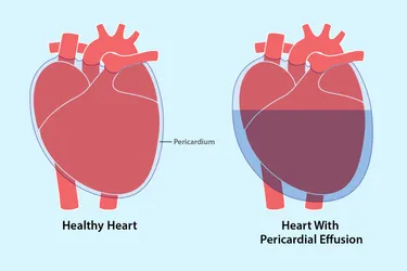 Pericardial effusion is the buildup of an excess amount of fluid in your pericardium, which is the sac that surrounds your heart and keeps it stable as it beats in your chest. (Photo Credit: iStock/Getty Images)