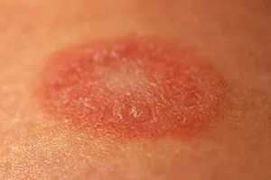Pityriasis rosea can be diagnosed with a biopsy or a blood test. (Photo credit: Mila722/Dreamstime)