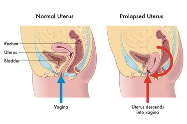 When pelvic support muscles weaken, the uterus can slip down into your vagina. Uterine prolapse is most common in people past menopause who've had one or more vaginal deliveries. (Illustration credit: Rob3000/Dreamstime)