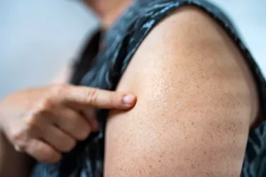 If a smallpox vaccination is successful, a scar will form where you received the shot. (Photo Credit: Moment RF/Getty Images)