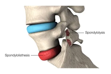 In spondylolisthesis, a vertebra moves out of place. One possible cause is spondylolysis, a crack or weakness in a vertebra. (Photo credit: Stocktrek Images/Science Source)