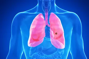 Almost 9 out of 10 people with lung cancer have non-small-cell lung cancer (NSCLC). Photo Credit: Science Photo Library/Getty Images