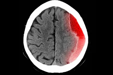 A subdural hematoma is a collection of blood outside the brain. (Photo credit: Image Source/Getty Images)