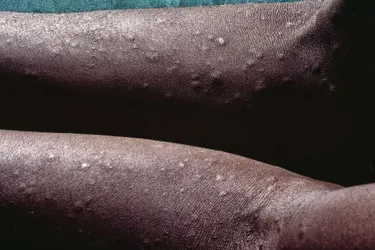 On darker skin, a syphilis rash may fade into your skin tone or be lighter in color. (Photo credit: Dr M.A. Ansary/Science Source)