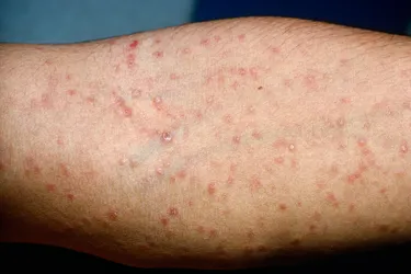 A syphilis rash on lighter skin will appear reddish. (Photo credit: Martin M. Rotker/Science Source)