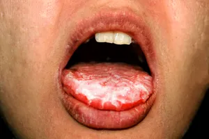 Thrush causes creamy white lesions on your tongue and inside your mouth that can often be painful. (Photo Credit: Iryna Timonina/Dreamstime)