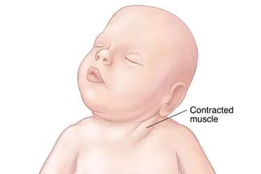If your baby has acquired torticollis, there are stretching exercises that may help. (Photo credit: Eric Olson/WebMD)