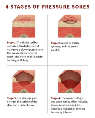4 Stages of Pressure Sores infographic