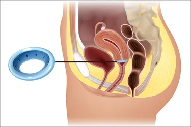 A vaginal pessary is a soft, removable device that goes in your vagina. It supports areas that are affected by pelvic organ prolapse (POP). This happens when the bladder, rectum, or uterus drops or bulges down toward the vagina. (Photo Credit: iStock/Getty Images)