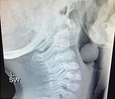 The photo shows a grape lodged in a child's airway.
