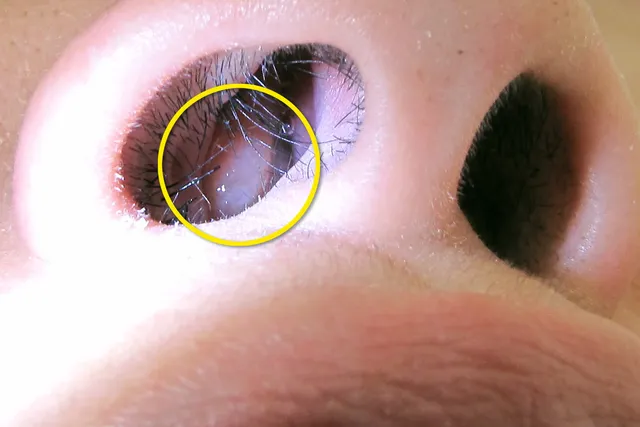 What’s Growing Inside My Nose?