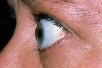 photo of eye in thyrotoxicosis