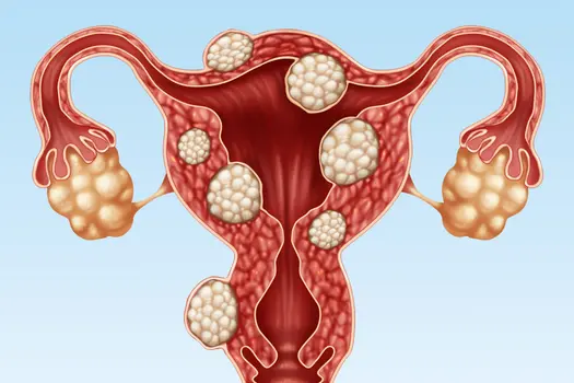 illustration of uterine fibroids